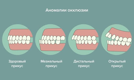 неправильный прикус