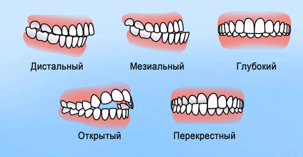 Виды прикуса зубов: особенности коррекции неправильного прикуса
